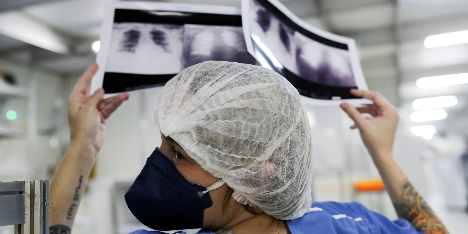 Diagnóstico tardio reduz chances de cura do câncer de pulmão